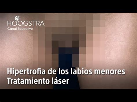 labios vaginales grandes|Labios vaginales grandes o hipertrofia vaginal